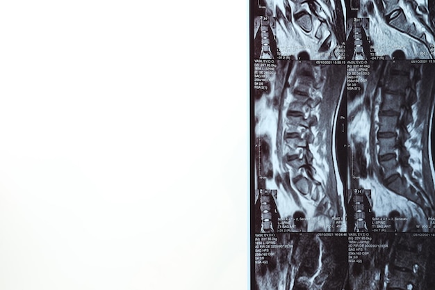 MRI of magnetische resonantie beeldvorming van de menselijke wervelkolom Plaats voor tekst