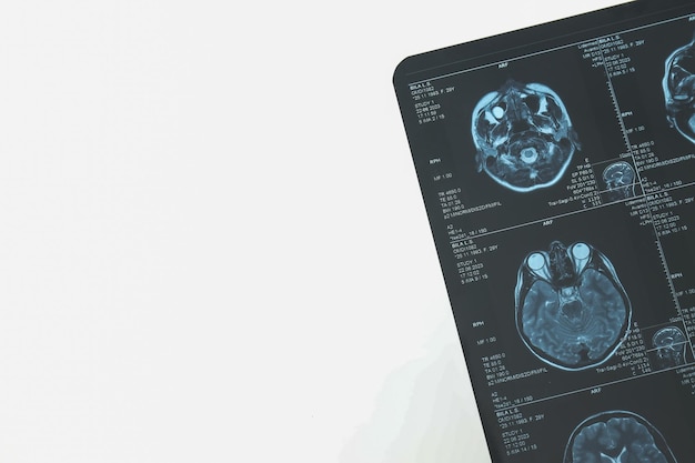 MRI of magnetische resonantie beeldvorming van het hoofd en de hersenen Plaats voor tekst