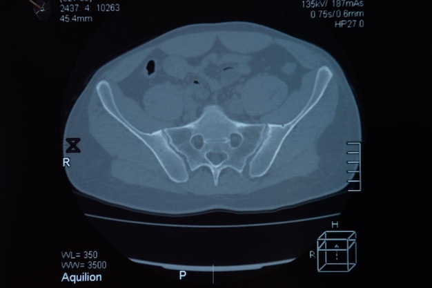 MRI sacro-iliacale articulatie Studie van een patiënt met spondyloartritis ankylopoetica