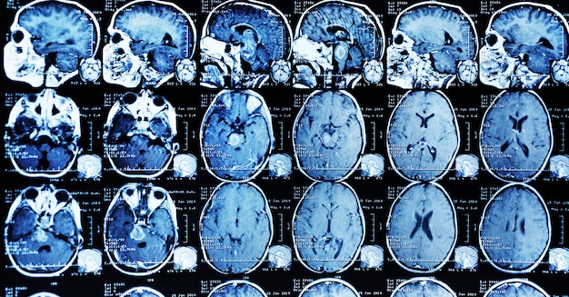 MRI scan of a patient with a tumor in the brain stem. 