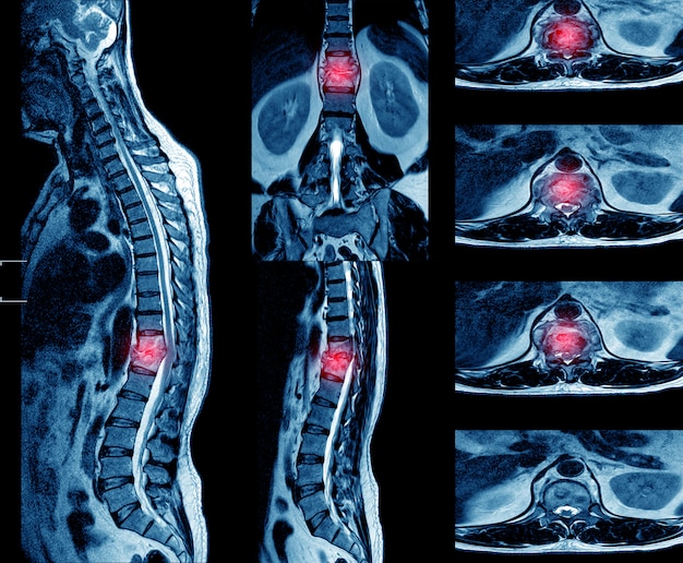 MRI OF THE THORACIC SPINE HISTORY: A 62-year-old male with suspected TB spine.