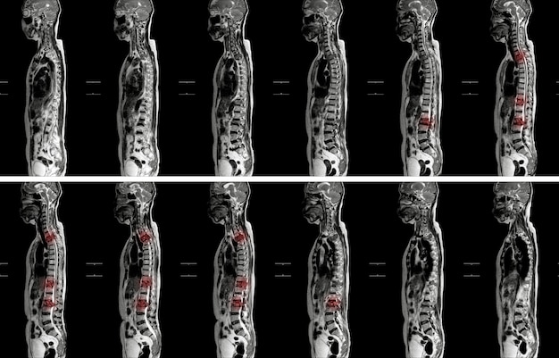 MRI OF THORACOLUMBAR SPINE IMPRESSION:  Moderate pathological compression of T11 and L2 levels with enhancing multiple marrow lesions at  T1, T10 toT12, L2, L3 to L5 levels.