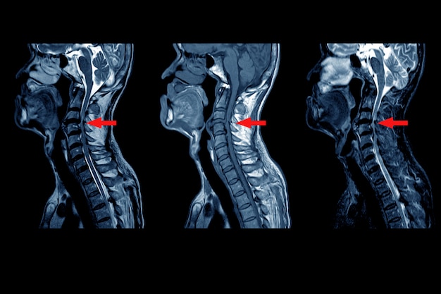 Mri van de cervicale stekel: matig tot ernstig achterste centrale schijfuitsteeksel van c3 / 4 tot c5 / 6 tussenwervelschijven met een kleine posterieure subligamentaire vochtophoping van 2,0 cm lang. op rode punt