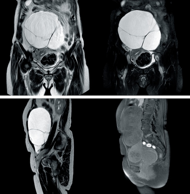 Foto mri van de gehele abstand geschiedenis: een 67-jarige vrouw met een enorme complexe cystische laesie in de buik