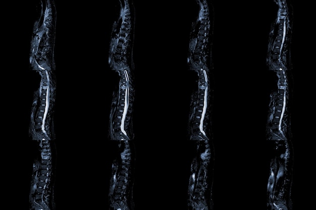 MRI van sagittale thoracale wervelkolom Geschiedenis van rugpijn met compressiefractuur van T9 Medisch en onderwijsconcept