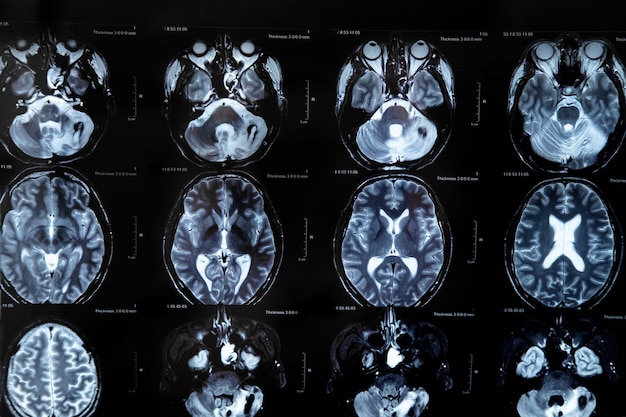 뇌종양이 있는 MRI 자기 공명 영상