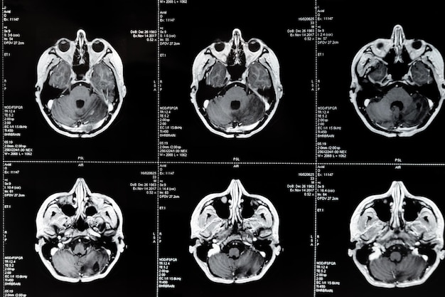 뇌종양이 있는 MRI 자기 공명 영상