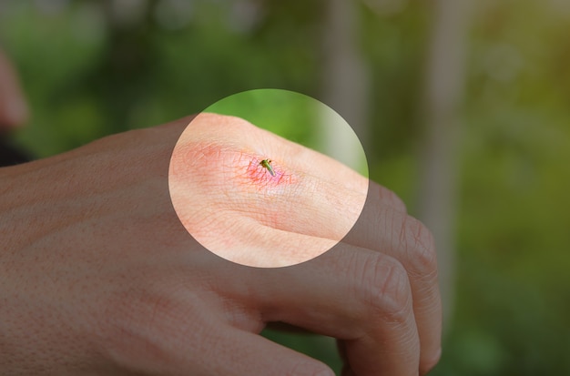 Mug zittend op de hand. Insecten bijten in de zomer. Gevaarlijke natuur. Jeukende lichaam.