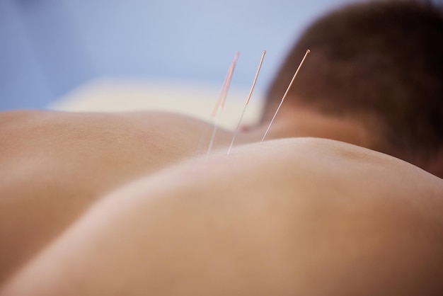Photo my back has been acting up lately a man using acupuncture needles               person