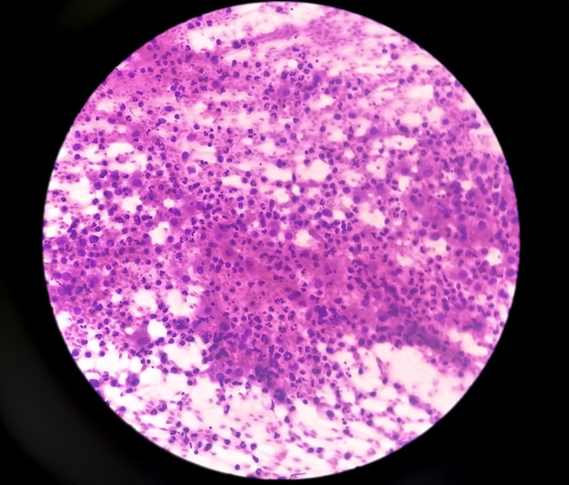 Mycobacterium tuberculosis in human supraclavicular lymph node FNAC slide cytopathologic microscopy