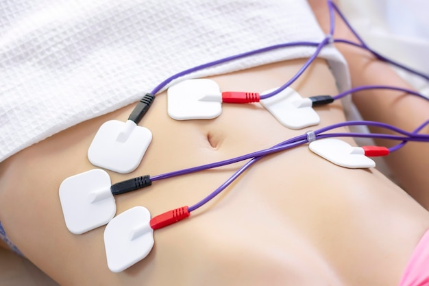 Myostimulation electrodes are placed on stomach