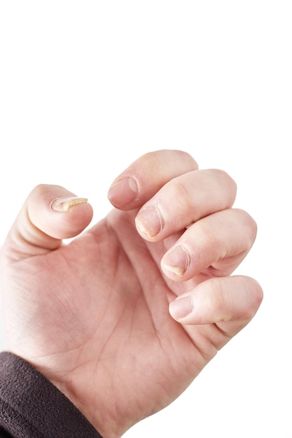 Close Up Of Fungus Nail Infection. Fungal Infection On Nails Hand, Finger  With Onychomycosis, Damage On Human Hand On Gray Concrete Wall Background.  Disease And Symptom Concept. Stock Photo, Picture and Royalty