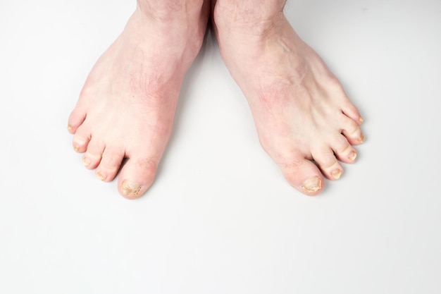 Nail fungus on legs disease fungal infection on nails legs
finger with onychomycosis damage on human legs