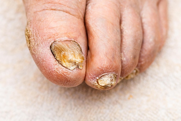 nail fungus on legs nail diseasefungus infection on nails of mans footcloseup shot