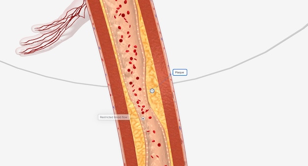 Photo narrowed blood vessel in lower extremity