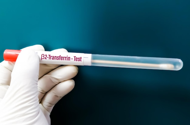 Nasal fluid sample Beta-2 Transferrin test for the diagnosis of CSF leak.