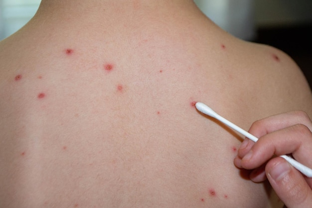 Natuurlijke vaccinatie Besmettelijke ziekte