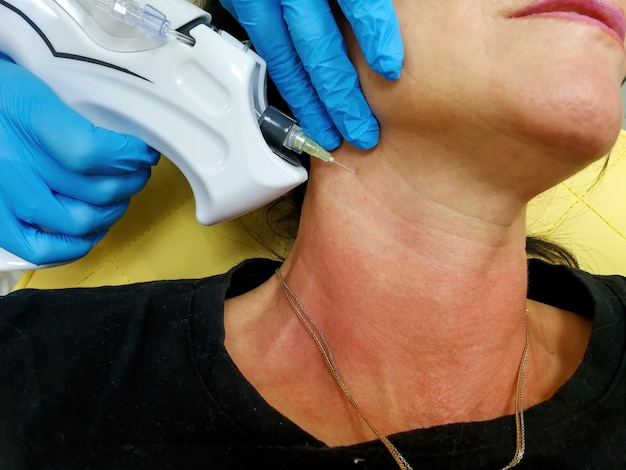 Neck rejuvenation with carbon dioxide carboxytherapy getting rid of wrinkles and a second chin