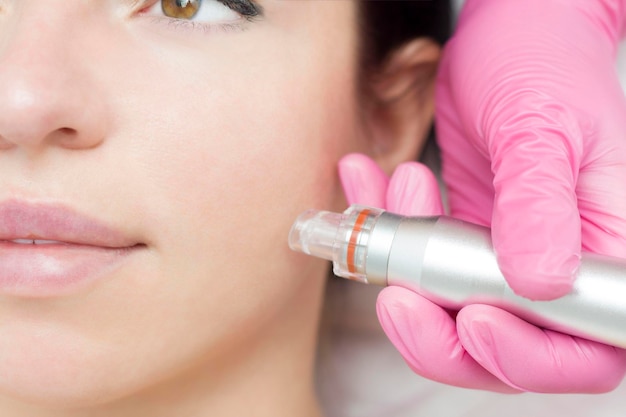 Microneedling Den Haag