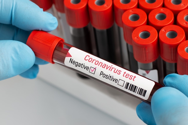 Foto esame del sangue di coronavirus negativo.