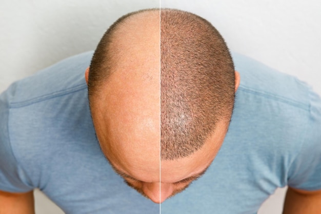 Фото Лучшее лечение от выпадения волос для мужчин