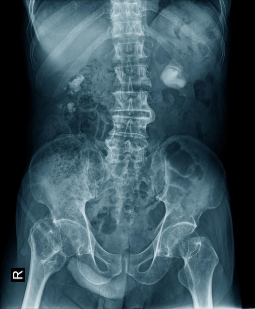 Niercalculus of niersteen xray afbeelding in blauwe toon foto