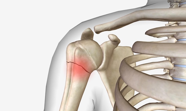 Photo the nondisplaced proximal humerus fracture