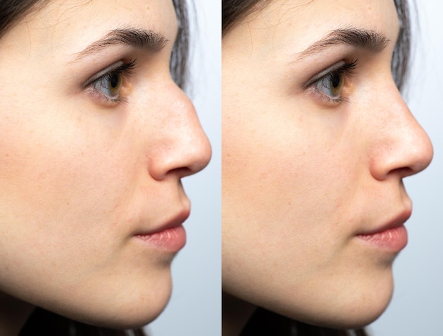 Nose before and after nasal filler surgery