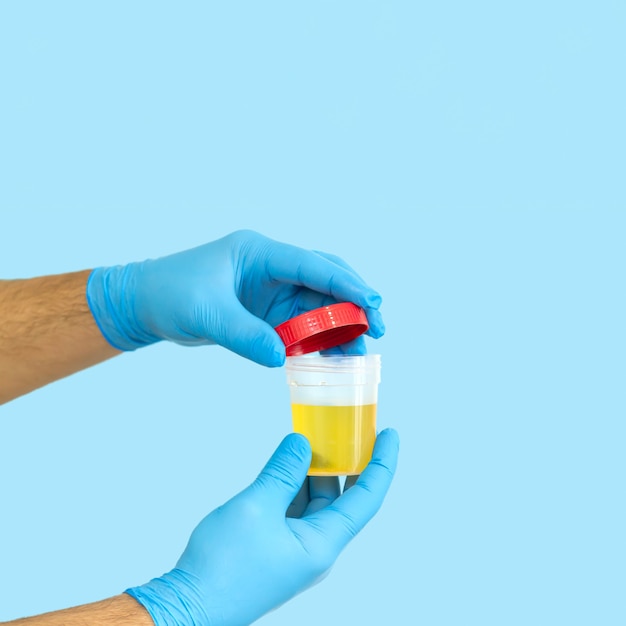 Photo nurse or medical worker opening urine sample container for medical urinalysis