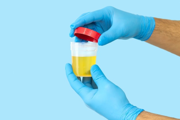 Nurse opening urine sample container for medical urinalysis