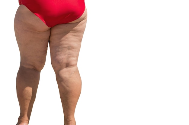 Foto gambe femminili obese persona in sovrappeso isolata problema causato da una dieta scorretta carico eccessivo sul cuore