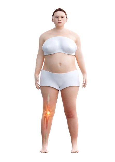 白い背景に分離された軟骨の摩耗と裂傷によって引き起こされる膝関節痛を持つ肥満女性