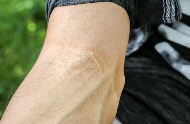 Old scar on man's arm. Accident in the past.