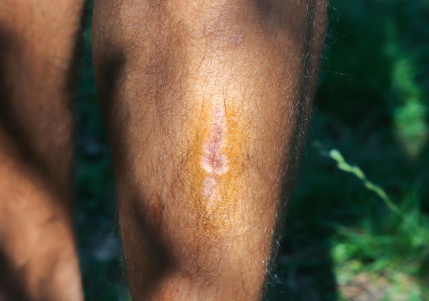 Old scar on man's leg. Accident in the past.