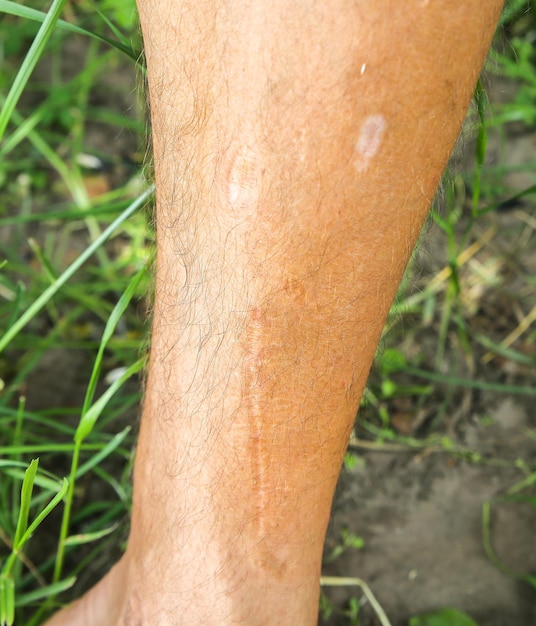 男の足の古い傷跡。過去の事故。