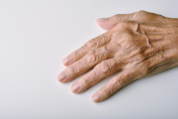Old woman's deform hands, Finger pain and stiffness from arthritis.