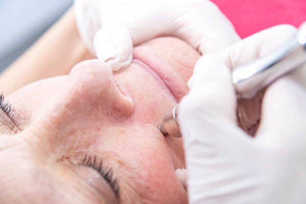 Older adult woman in a spa performing diamond tip treatment removing blackheads