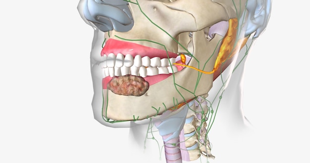 Photo once a tumor has spread into nearby lymph nodes it is considered a stage three cancer