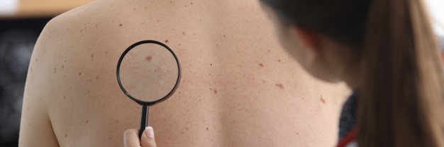 Oncologist holds magnifying glass in hand and examines pigmented nevi on patient's back in clinic