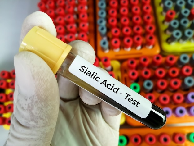 Foto onderzoeker houdt bloedmonster voor siaalzuur testen in laboratorium.