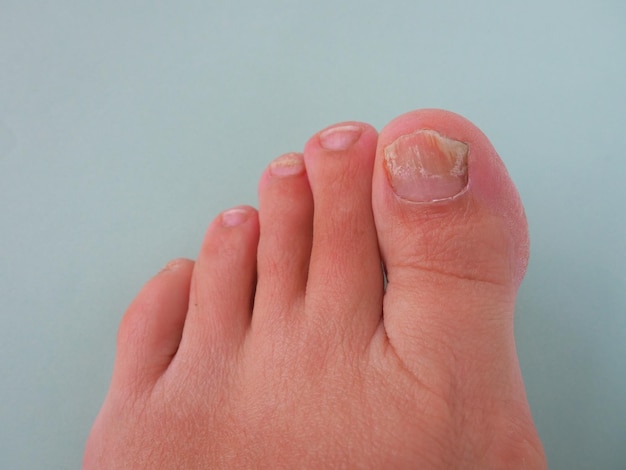 Onychomycose met teennagel schimmelinfectie op lichte achtergrond Vijf tenen van de linkervoet van een blanke vrouw Het effect van de behandeling is merkbaar op de thumbnail Hergroei van een gezonde nagel