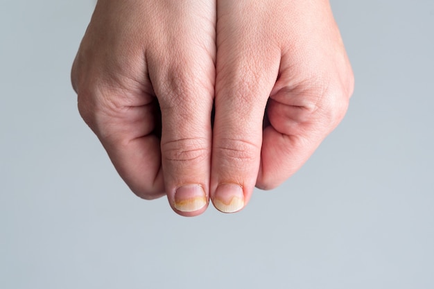 onychomycosis or fungal nail infection on damaged nails after gel polish, onychosis, nail diseases