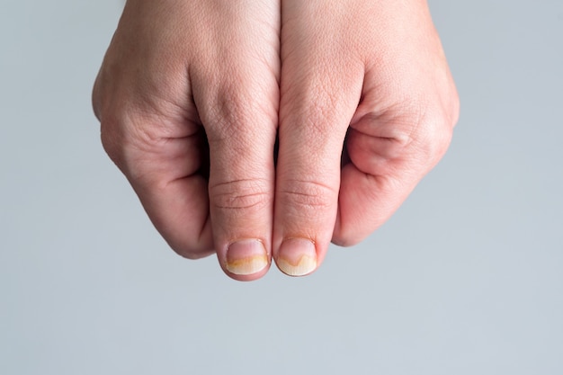 Photo onychomycosis or fungal nail infection on damaged nails after gel polish, onychosis, nail diseases