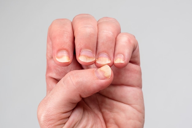 onychomycosis or fungal nail infection on damaged nails after gel polish, onychosis, nail diseases