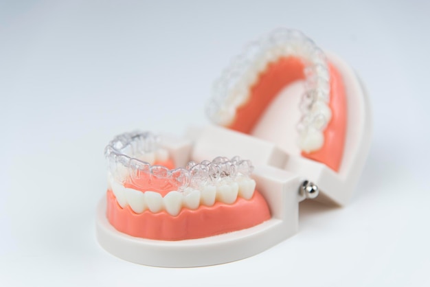 Onzichtbare en afneembare aligners voor het uitlijnen van tanden