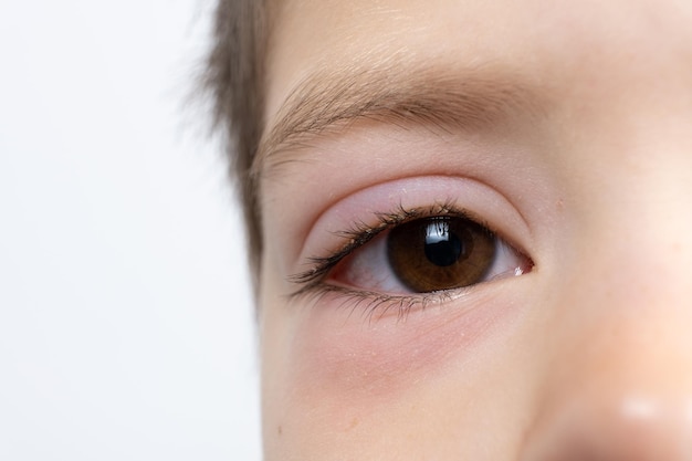 Oog van een kind met conjunctivitis ontsteking van het bindvlies