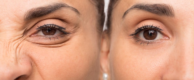 Oog van vrouw met en zonder rimpels voor en na cosmetische behandeling