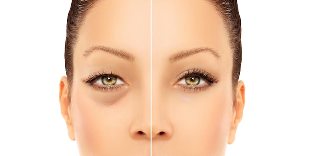 Ooglidcorrectie van het onderste ooglid Ooglidcorrectie van het bovenste ooglid Voor en na cosmetische ingrepen