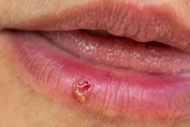 Photo open wound of a blister caused by cold sores