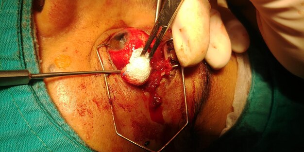 Photo ophthalmologycal eye surgery